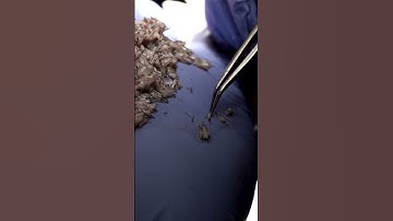 Thumbnail of Hair Transplant in our patient. 2500 grafts | Care4Hair