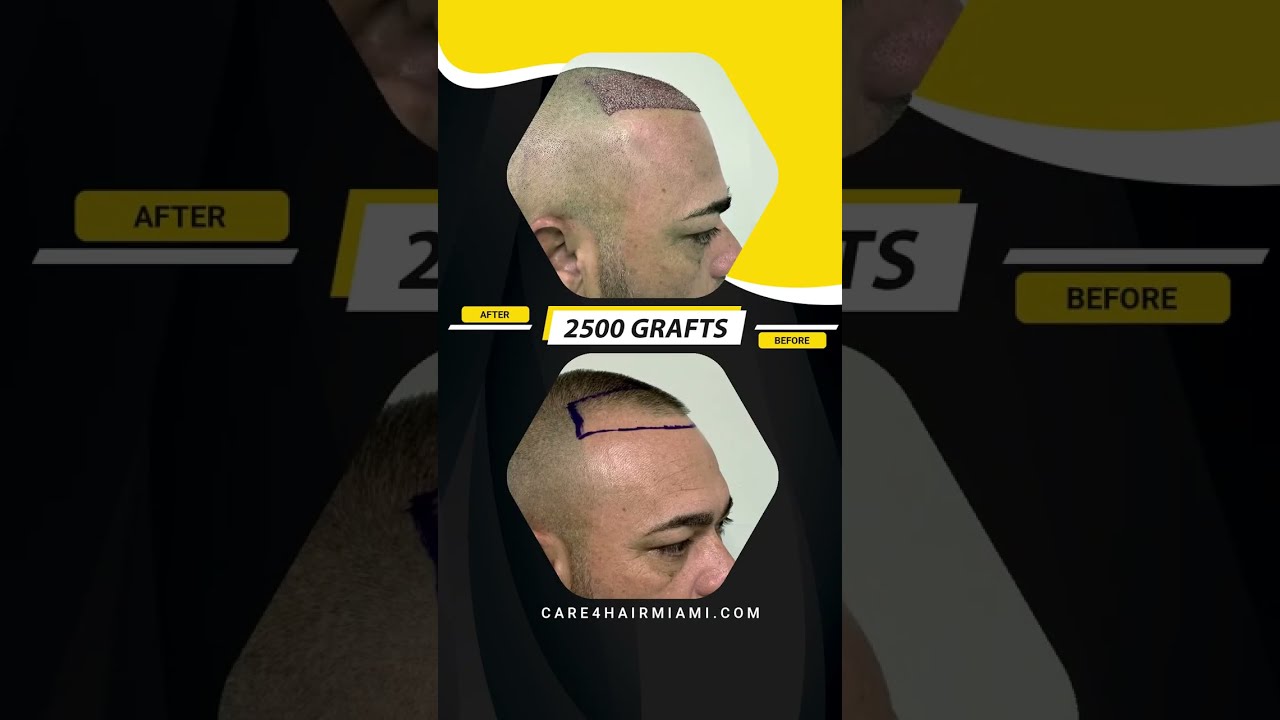 Hair Transplant in our patient. 2500 grafts | Care4Hair - YouTube