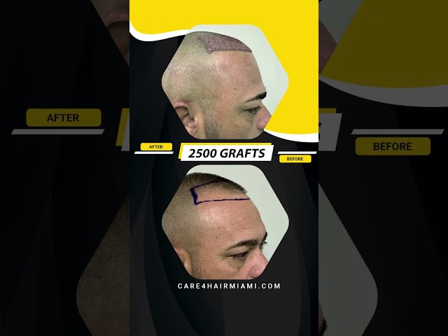 Hair Transplant in our patient. 2500 grafts | Care4Hair class=