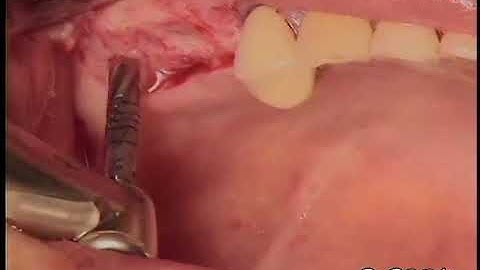 Sinus Augmentation using Hydrodynamic Piezoelectric Internal Sinus Elevation (HPISE)