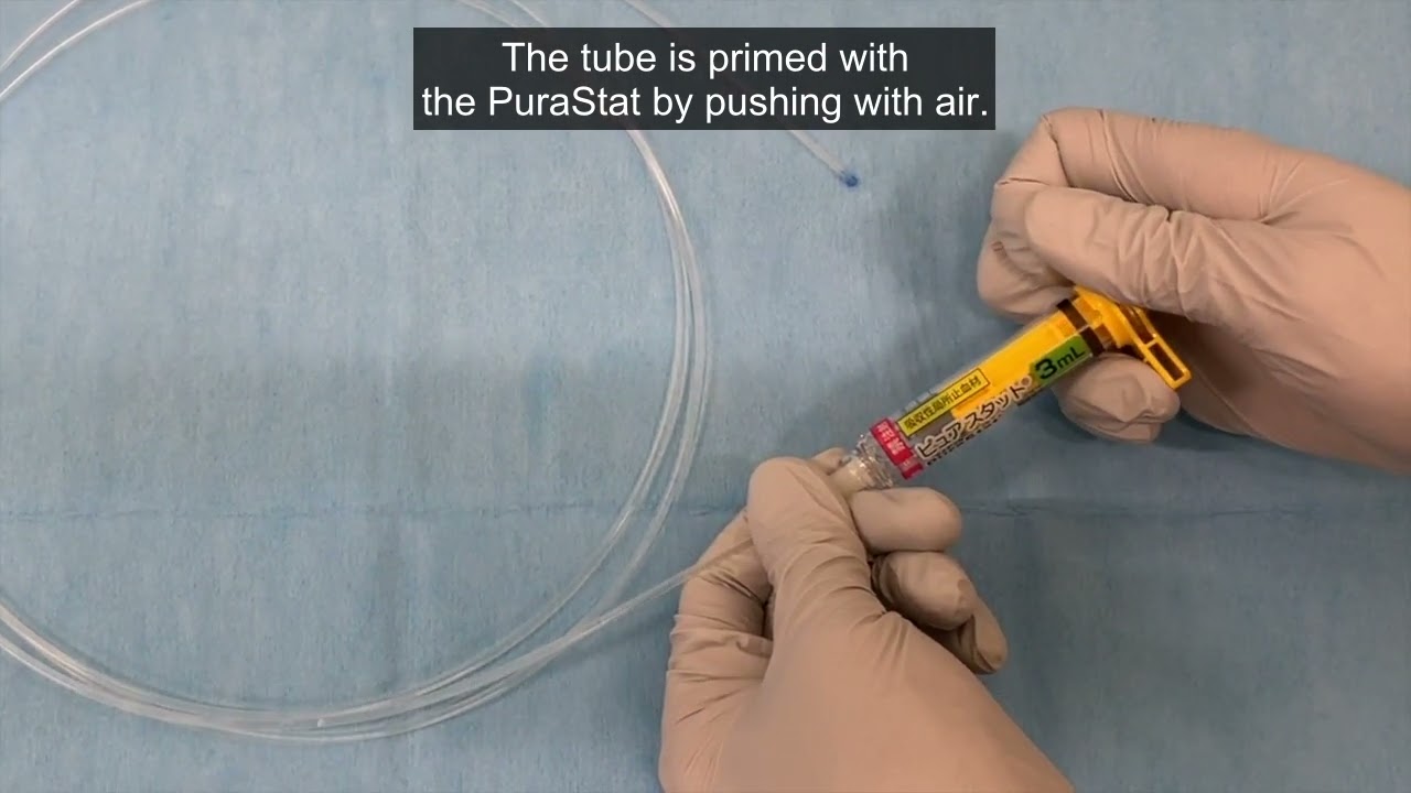 Hemostatic Techniques Using PuraStat® for Bleeding After Endoscopic Sphincterotomy (EST)