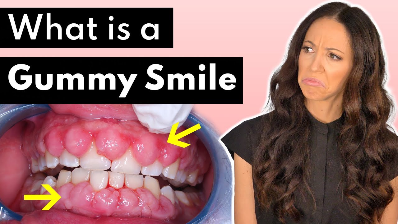 Gummy Smiled Explained | Gingival Hyperplasia