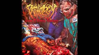 Pathology - Eviscerated Human Torso