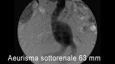 Endovascular AAA repair  with Endurant graft Medtronic - by Dr M. Llambro & Dr A. Politi