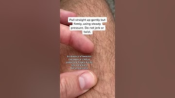 Doctor Teaches: HOW TO REMOVE A TICK