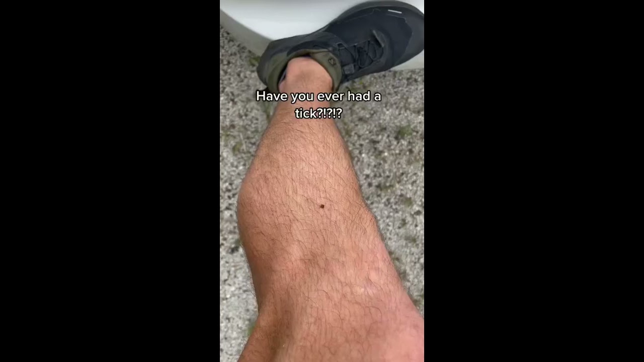 Doctor Teaches HOW TO REMOVE A TICK