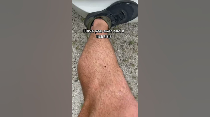Doctor Teaches: HOW TO REMOVE A TICK