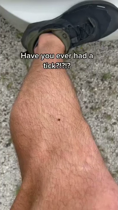 Doctor Teaches: HOW TO REMOVE A TICK