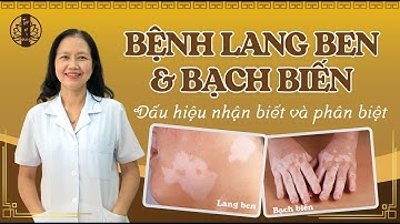 DẤU HIỆU PHÂN BIỆT BỆNH LANG BEN VÀ BẠCH BIẾN - CÁCH ĐIỀU TRỊ LANG BEN và BẠCH BIẾN theo YHCT