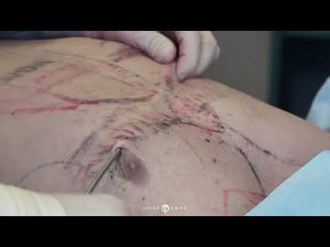 HD-Lipo | CHEST | West Hollywood, CA | Dr. Jason Emer
