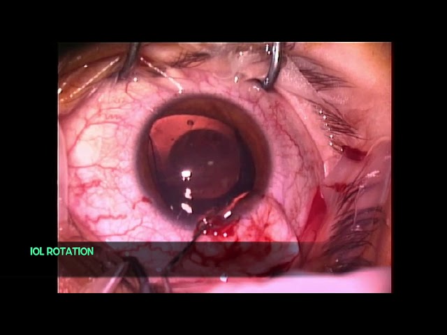 Phakic IOL Implantation implantable collamelar lens