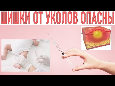 ШИШКИ ОТ УКОЛОВ | Как убрать шишки от уколов