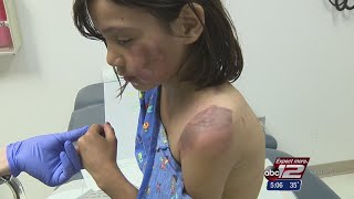 Ramen noodle burns sending children to ER