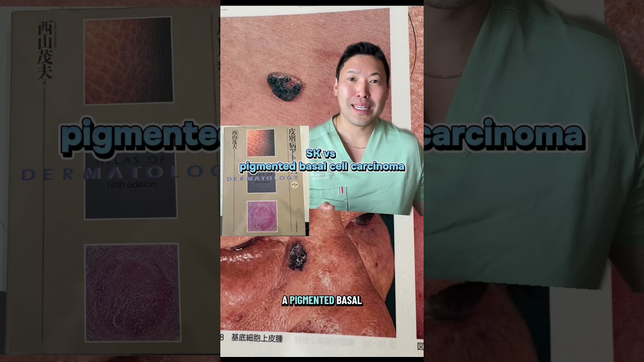 This Looks Harmless But Could Be Skin Cancer