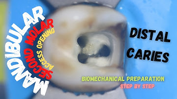 Access Opening in Mandibular Second Molar with Distal Caries