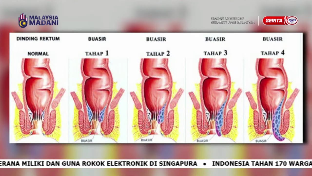 17 MEI 2025 – SPM – BUASIR BUKAN AIB : TETAPI ISYARAT GAYA HIDUP PERLU DIUBAH