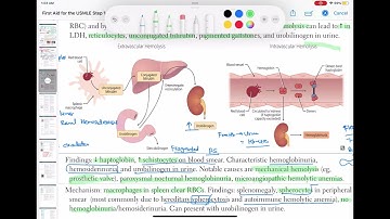 Extravascular hemolysis  #haematology 44 #First Aid USMLE Step 1 in Urdu/Hindi |