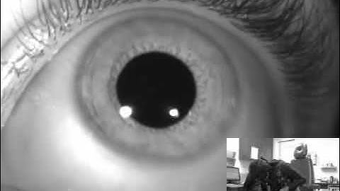 Right Posterior Cupulolithiasis