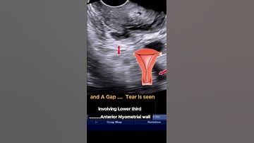 D&C Complication - Uterine Wall Tear  #ultrasound