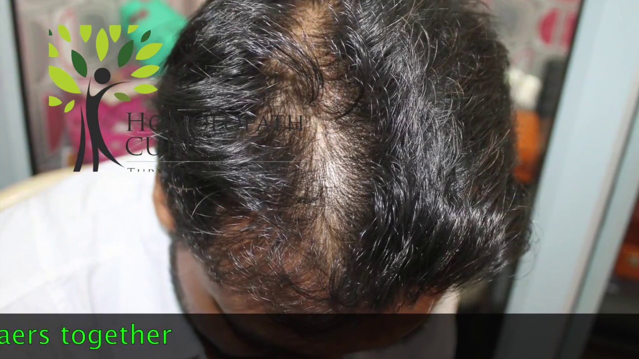 Androgenic alopeciaHomeopathic medicine for androgenic alopecia explain   YouTube