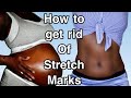 HOW TO PREVENT AND REMOVE STRETCH MARKS!!!!!!! | Fumi Desalu-Vold