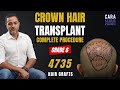 Crown hair transplant  crown hair restoration in india by dr asif  cara clinic mumbai