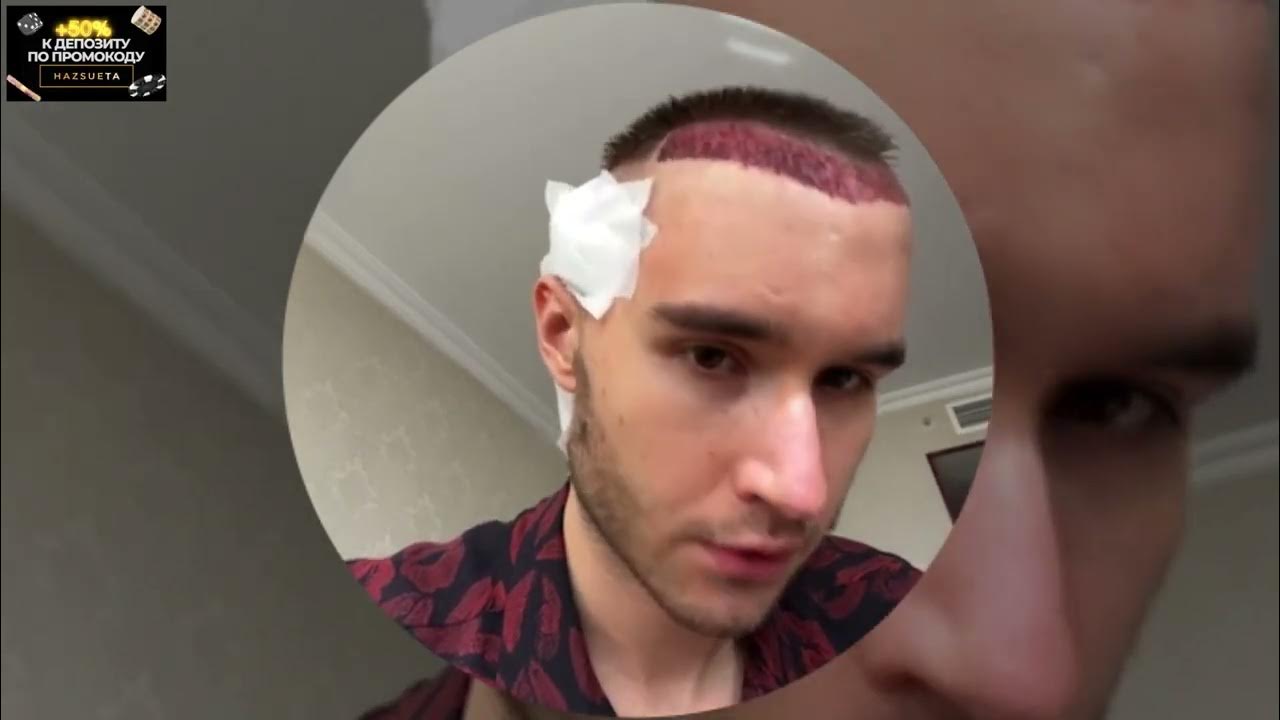 КОРЕШ ПОСЛЕ ОПЕРАЦИИ ПО ПЕРЕСАДКЕ ВОЛОС - YouTube