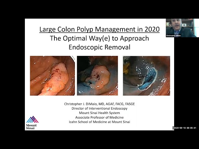 Large Colon Polyp Management in 2020: The Optimal Way(e) to Approach Endoscopic Removal