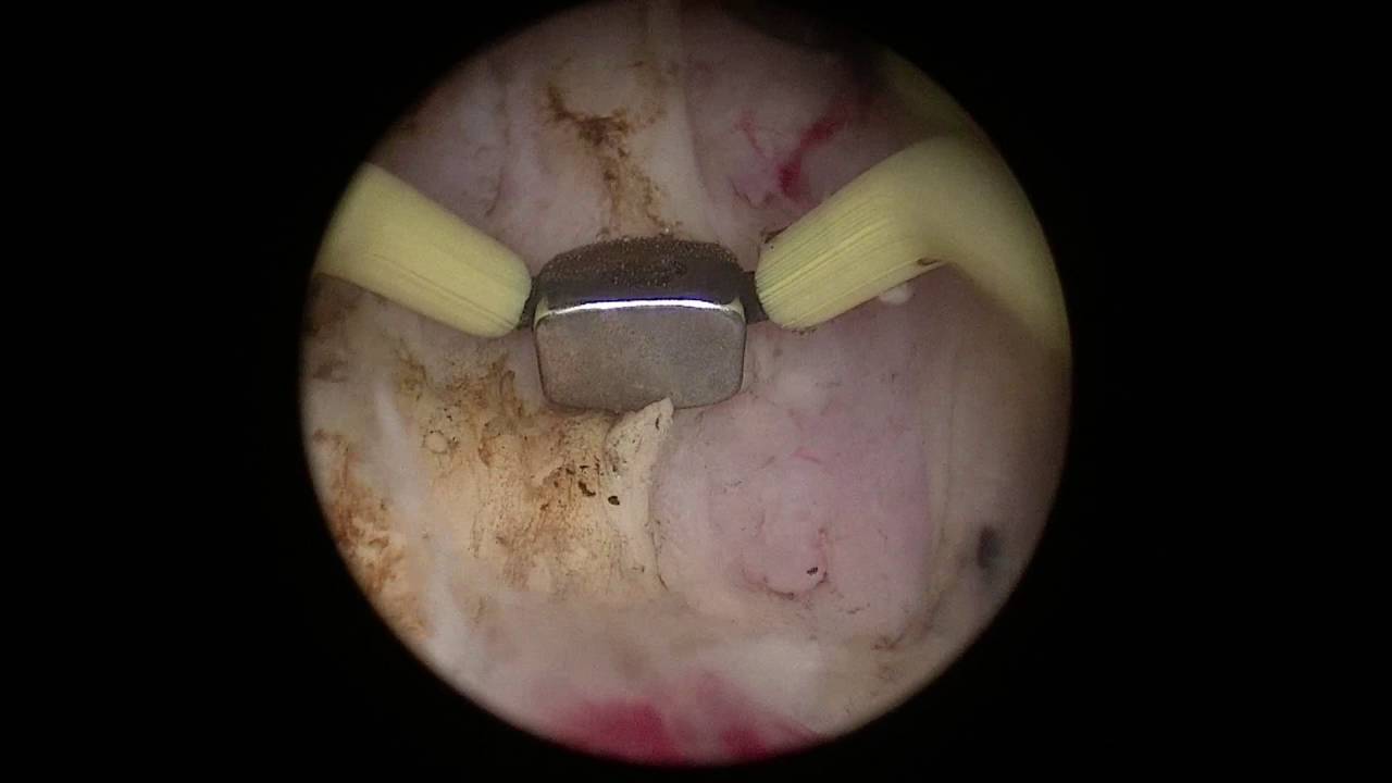 bipolar enucleation of prostate)