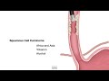 HCC 1475-2d-Pathology of Esophagus - Esophageal Cancer