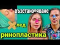 НАПРАВИХМЕ СИ РИНОПЛАСТИКА ЗАЕДНО