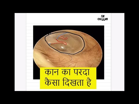 वीडियो: कान के पर्दे कैसे दिखते हैं?