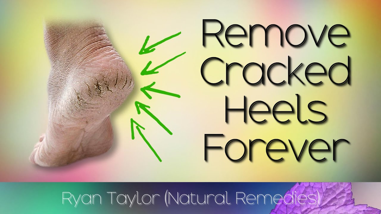 Say Goodbye To Cracked Heels With These Easy Home Remedies | Pragativadi |  Odisha News, Breaking News Odisha, Latest Odisha News