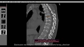 видео: Разбор КТ позвоночник + xray калькуляторы картинка: Разбор КТ позвоночник + xray калькуляторы