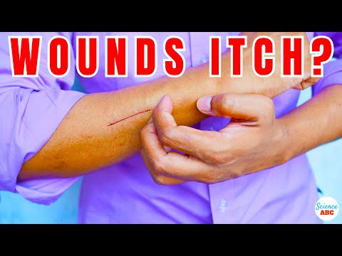Videó: Viszketnek a gyógyuló sebek?