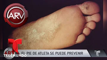 ¿Cómo eliminar el pie de atleta grave?