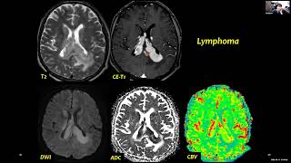 DSC, DCE and ASL for Brain Tumors Imaging (Perfusion MRI Techniques).