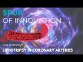 Abbott's New Coronary Lithotripsy | Spur of the Moment