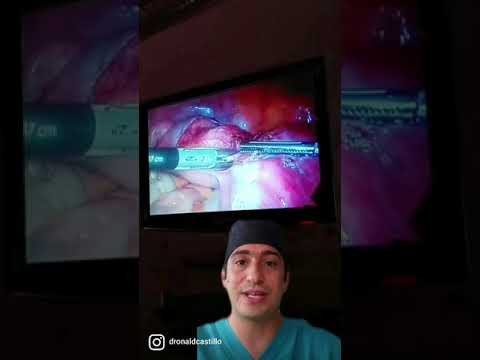Video: ¿Se puede realizar una histerectomía laparoscópica sin morcelación?