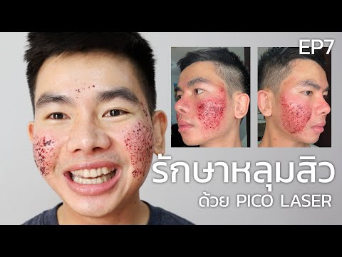 [รีวิว] รักษาหลุมสิวครั้งที่ 7 ด้วยเลเซอร์ Picosecond laser หลุมสิว แก้รูขุมขนกว้าง