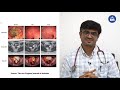 100 cure for cancer is it true  dr chandrakanth m v hindi