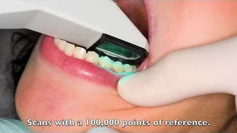 iTero - The Digital Impression Scanner