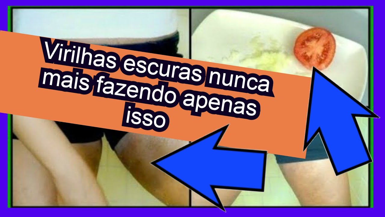 Remédio Caseiro Para íngua Na Virilha - RETOEDU