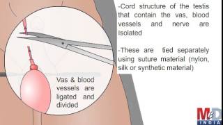 Orchidectomy