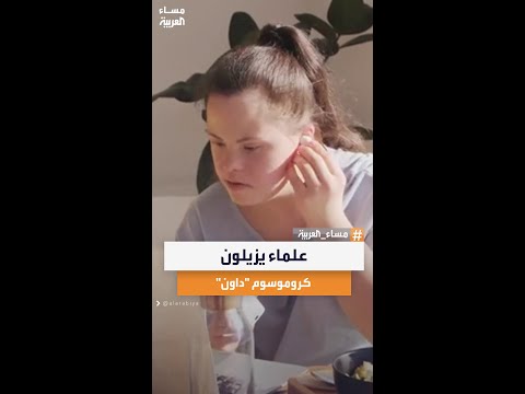 خطوة نحو علاج متلازمة داون باحثون يابانيون ينجحون في إزالة الكروموسوم الزائد