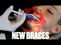 EXPANDER TAKEN OUT AND NEW BRACES PUT ON | GETTING BRACES TIGHTENED AND EXPANDER REMOVED