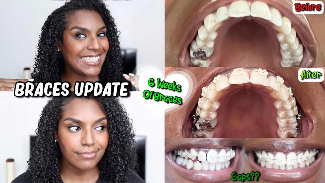 MY BRACES GAVE ME GAPS IN MY TEETH!! 6 Weeks Braces Update Adult