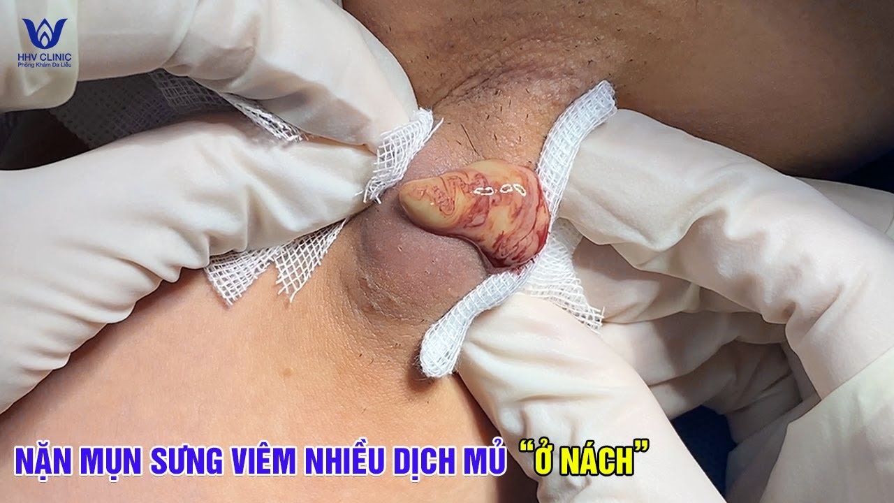 Nặn mụn nhọt ở nách, mủ trào ra không ngờ nhiều đến vậy - Relax Every Day.