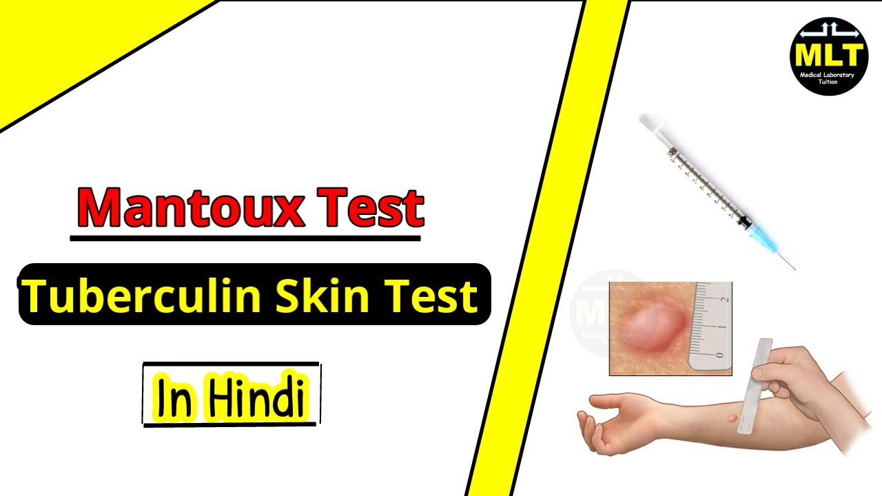 Tuberculin Skin Test Mantoux Test Procedure And Principle Youtube