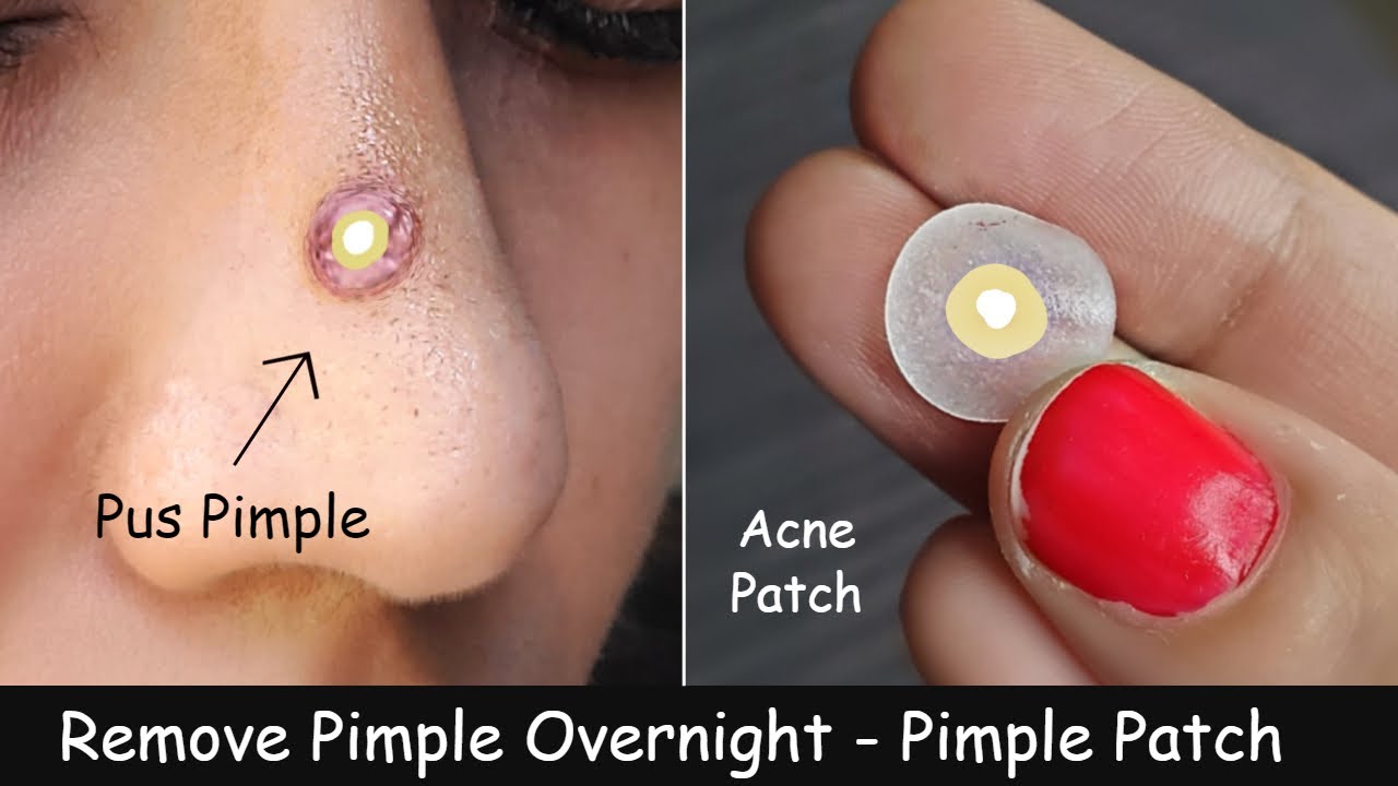 Face pimples Free Stock Photos, Images, and Pictures of Face pimples